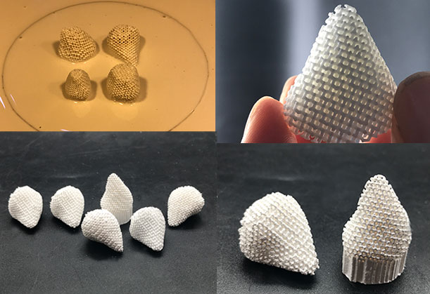 Implantation of hydroxyapatite artificial eye for orbital deformity