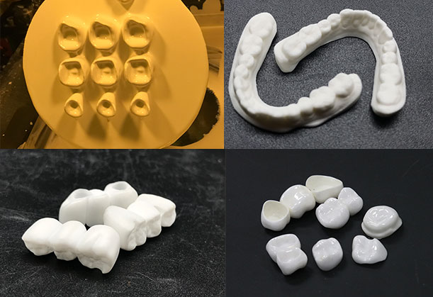 Oral cavity tooth restoration zirconia ceramic tooth
